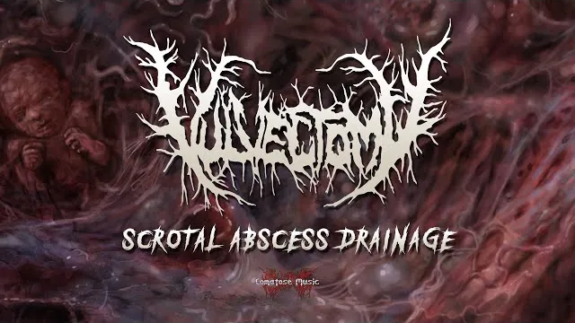 Vulvectomy - Scrotal Abscess Drainage